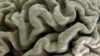 Study: Gene May Cause Alzheimer’s in Some Cases